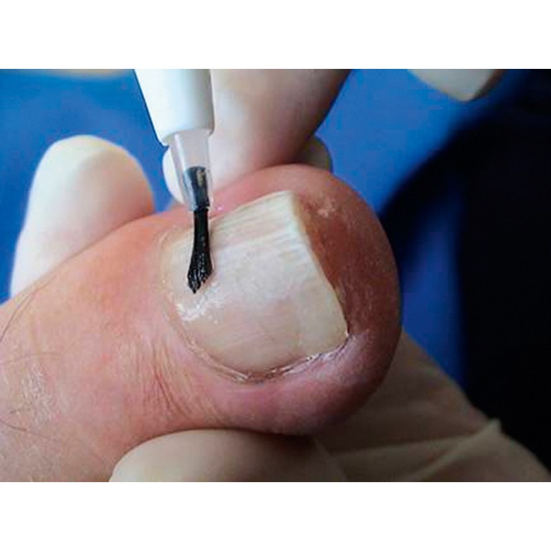 Espátula para «bonding», portapinceles, J3M Diffusion, Podiatech